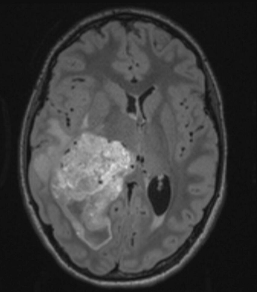 Choroid plexus carcinoma (Radiopaedia 91013-108553 Axial FLAIR C+ 135).jpg