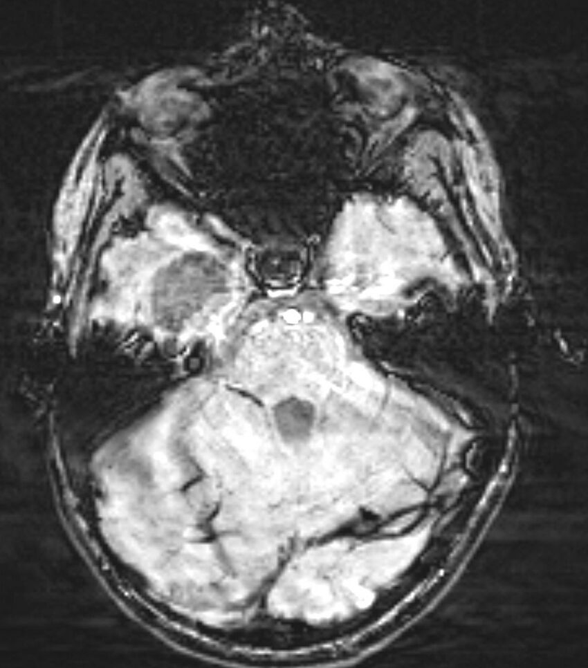 Choroid plexus carcinoma (Radiopaedia 91013-108553 Axial SWI 29).jpg