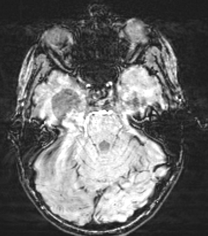 Choroid plexus carcinoma (Radiopaedia 91013-108553 Axial SWI 31).jpg
