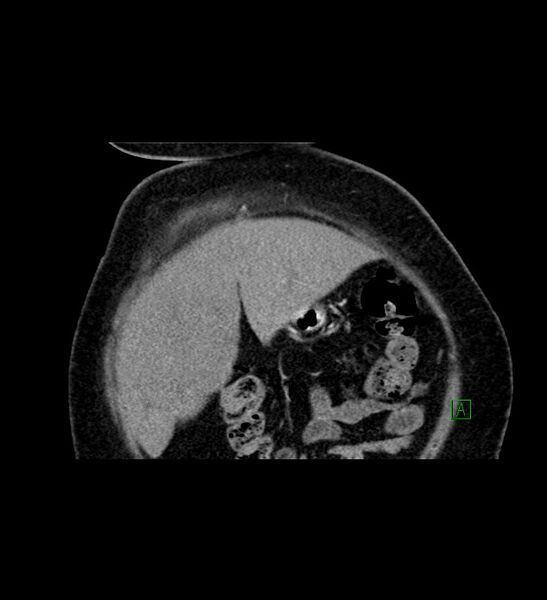 File:Chromophobe renal cell carcinoma (Radiopaedia 84239-99519 C 16).jpg