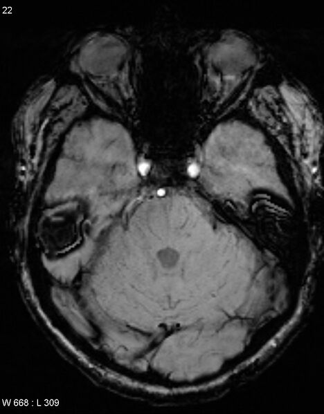 File:Chronic lymphocytic inflammation with pontine perivascular enhancement responsive to steroids (CLIPPERS) (Radiopaedia 37520-39374 Axial SWI 21).jpg