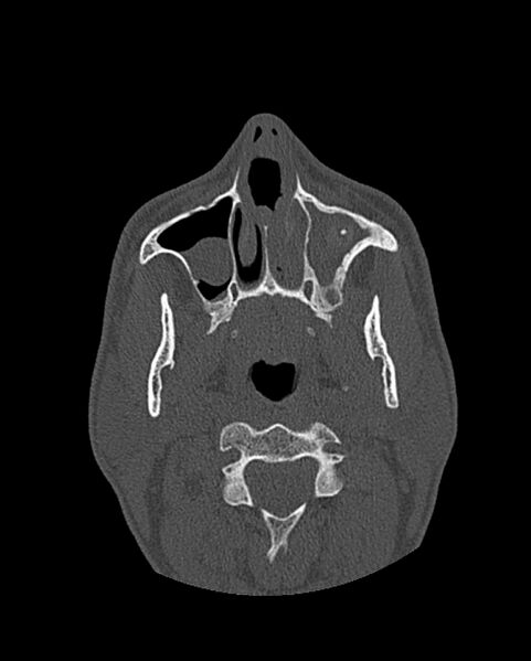 File:Chronic maxillary sinusitis caused by a foreign body (Radiopaedia 58521-65676 Axial bone window 87).jpg
