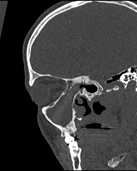 File:Chronic maxillary sinusitis caused by a foreign body (Radiopaedia 58521-65676 Sagittal bone window 33).jpg