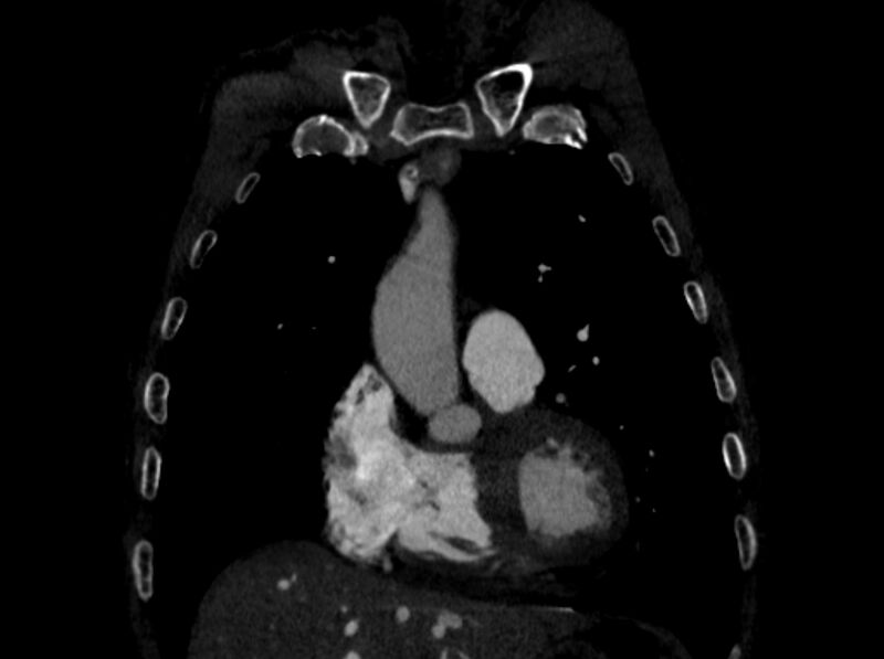 File:Chronic pulmonary embolism (Radiopaedia 91241-108843 A 23).jpg