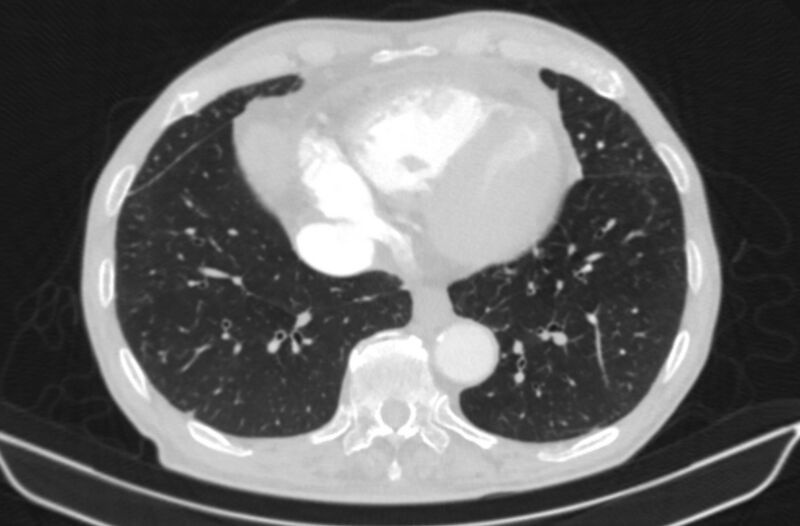 File:Chronic pulmonary embolism (Radiopaedia 91241-108843 Axial lung window 70).jpg