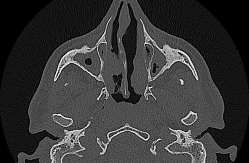 File:Chronic rhinosinusitis (Radiopaedia 65079-74075 Axial bone window 27).jpg