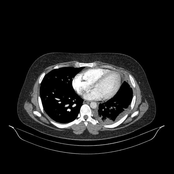 File:Chronic thromboembolic pulmonary hypertension (CTEPH) (Radiopaedia 74597-85532 Axial C+ CTPA 64).jpg