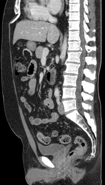 File:Clear cell renal cell carcinoma (Radiopaedia 61449-69393 G 57).jpg