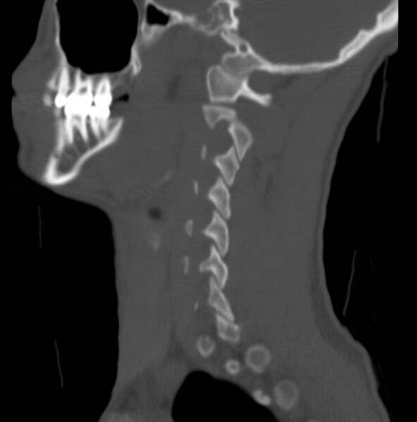 File:Cleft of the posterior arch of C1 mimicking fracture (Radiopaedia 40201-42721 Sagittal bone window 15).jpg