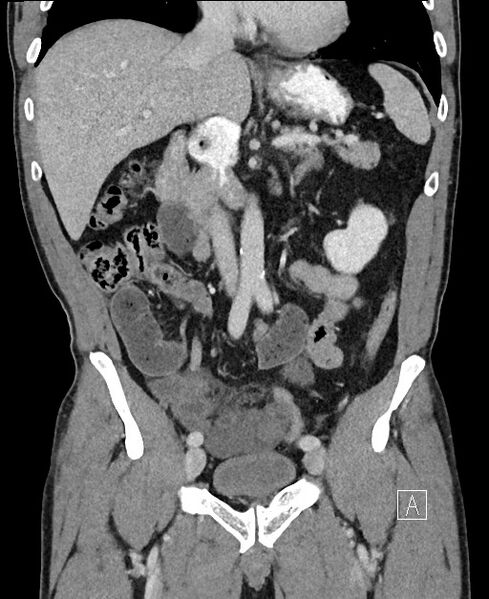 File:Closed loop small bowel obstruction - internal hernia (Radiopaedia 57806-64778 A 52).jpg