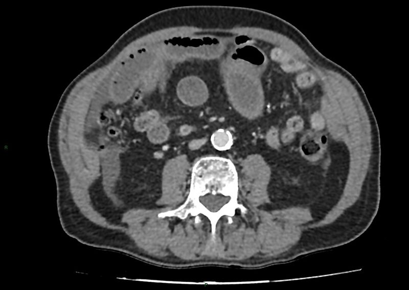 File:Closed loop small bowel obstruction with ischemia (Radiopaedia 84180-99456 A 61).jpg
