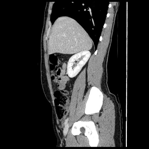 File:Co-existing acute appendicitis and epiploic appendagitis (Radiopaedia 61789-69911 B 27).jpg