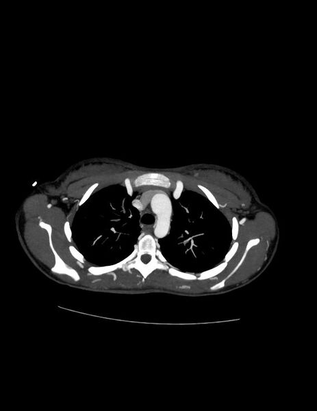 File:Coarctation of the aorta (Radiopaedia 27458-27657 D 8).jpg