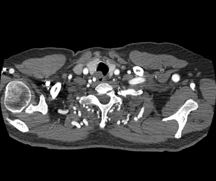 File:Coarctation of the aorta (Radiopaedia 53752-59822 A 14).jpg