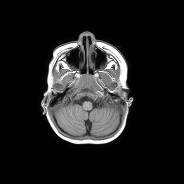 File:Cochlear nerve aplasia - unilateral (Radiopaedia 87910-104413 Axial T1 6).jpg