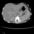 Colocolic fistula - Crohn disease (Radiopaedia 57063-63955 A 13).jpg