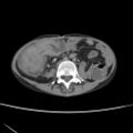 Colocolic fistula - Crohn disease (Radiopaedia 57063-63955 A 48).jpg