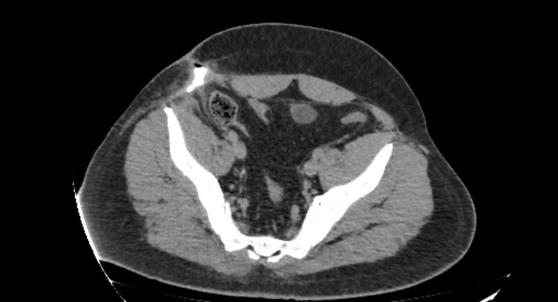 File:Colocutaneous fistula (Radiopaedia 56401-63062 Axial Fistulography 43).jpg
