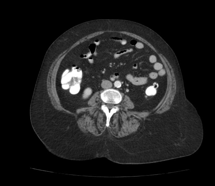 File:Colonic diverticulosis (Radiopaedia 22934-22957 A 39).jpg