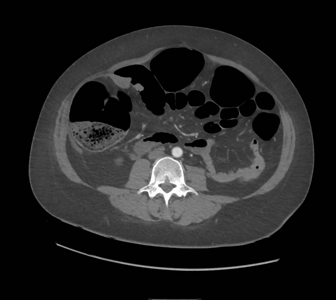 File:Colonic pseudo-obstruction (Radiopaedia 79752-92980 A 104).png