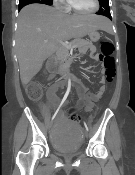File:Colonic pseudo-obstruction (Radiopaedia 79752-92980 B 33).png
