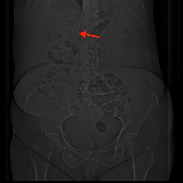 File:Common bile duct stent (Radiopaedia 74406).jpg