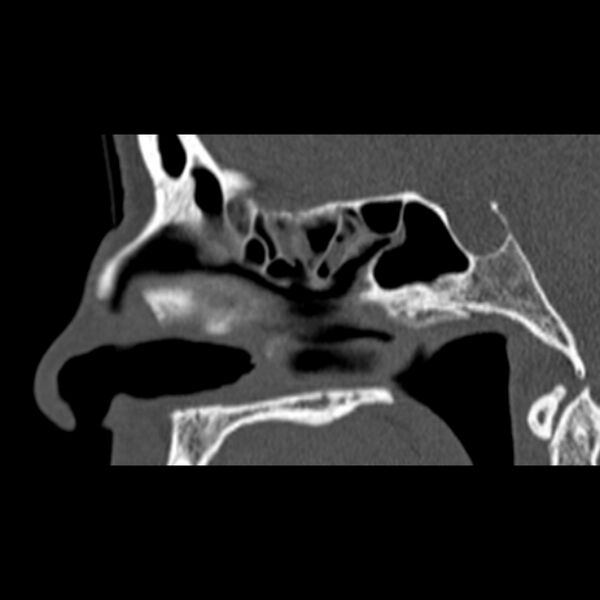 File:Nasal septal perforation (Radiopaedia 25030-25289 Sagittal bone window 32).jpg