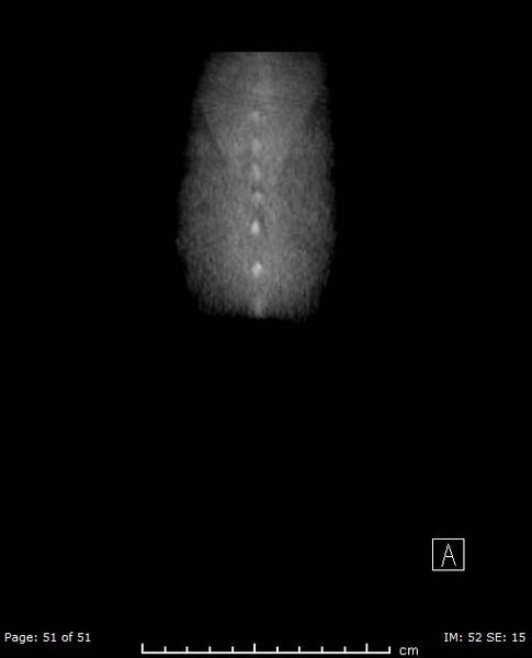 File:Nephroblastomatosis (Radiopaedia 41934-44935 B 51).jpg