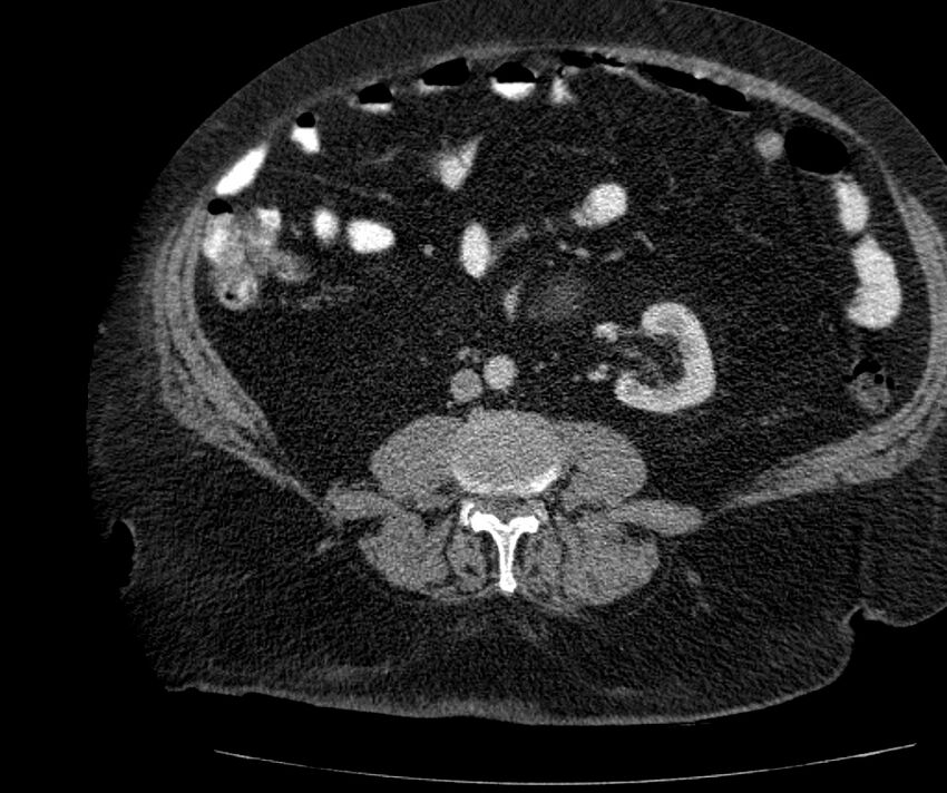 Nephroptosis with inguinal hernia containing perirenal fat (Radiopaedia 56632-63391 C 198).jpg