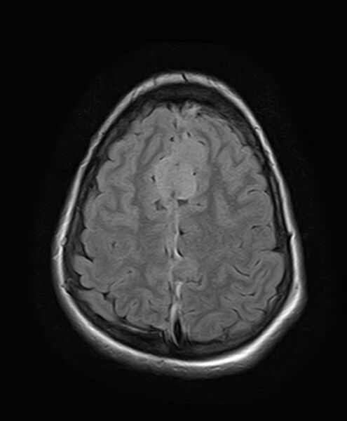 File:Neurofibromatosis type 2 (Radiopaedia 66211-75401 Axial FLAIR 23).jpg