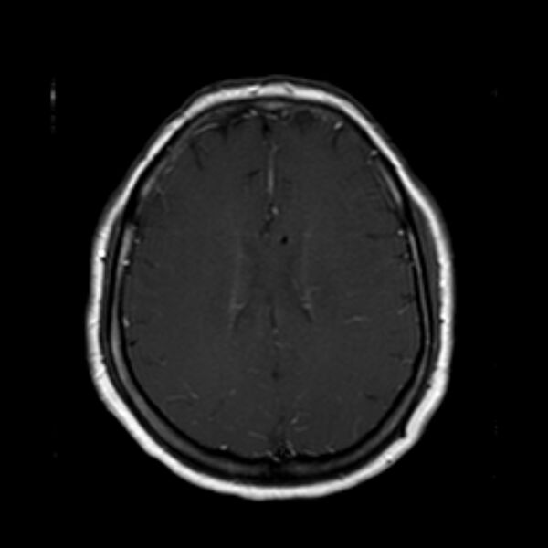 File:Neurofibromatosis type 2 (Radiopaedia 67470-76871 Axial T1 C+ 16).jpg