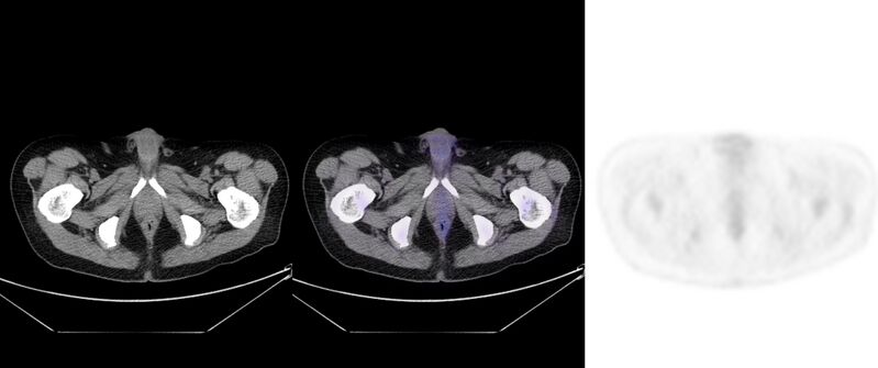 File:Non-Hodgkin lymphoma involving seminal vesicles with development of interstitial pneumonitis during Rituximab therapy (Radiopaedia 32703-33752 ax CT Fus PET 64).jpg