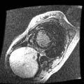 Non-compaction of the left ventricle (Radiopaedia 38868-41062 E 9).jpg