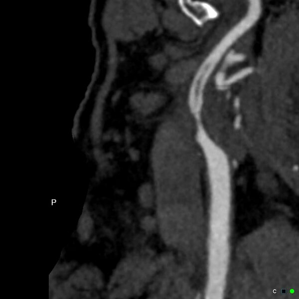 File:Non-occlusive intraluminal internal carotid artery thrombus (Radiopaedia 37751-39658 A 13).jpg