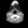 Normal CT of the neck (Radiopaedia 14575-14500 Axial C+ 41).jpg