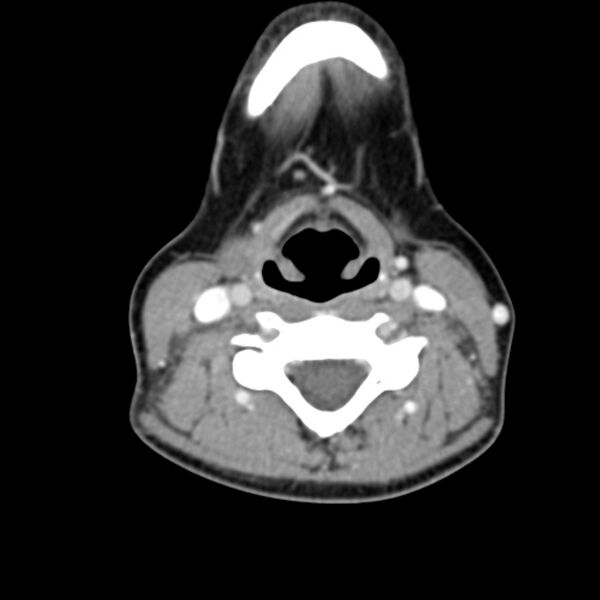 File:Normal CT of the neck (Radiopaedia 14575-14500 Axial C+ 41).jpg