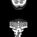 Normal CT of the neck (Radiopaedia 14575-14500 Coronal C+ 50).jpg
