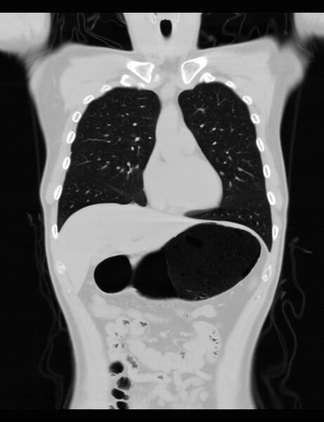 File:Normal CT virtual gastroscopy (Radiopaedia 29960-30501 F 14).jpg