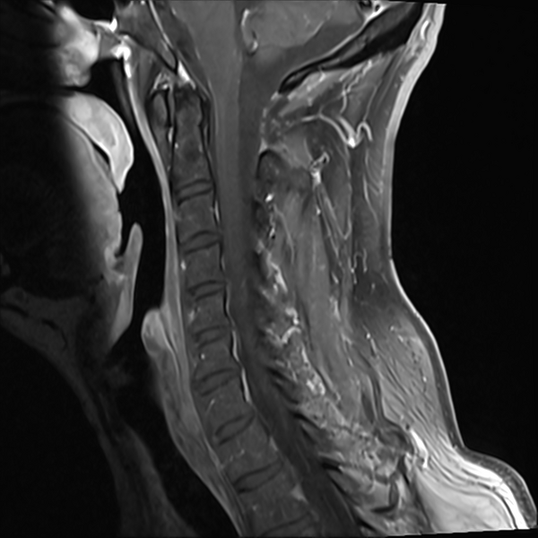 File:Normal MRI cervical spine (infection protocol) (Radiopaedia 53916-60039 I 8).png
