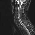 Normal cervical spine MRI (Radiopaedia 38418-40496 Sagittal STIR 7).jpg