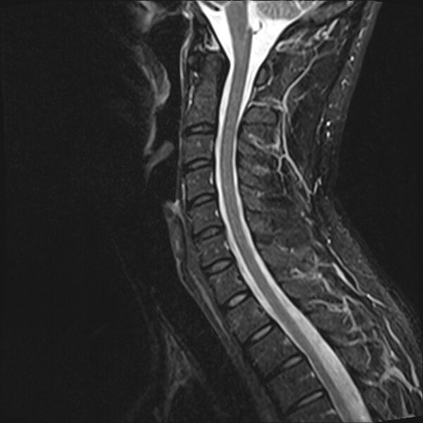 File:Normal cervical spine MRI (Radiopaedia 38418-40496 Sagittal STIR 7).jpg