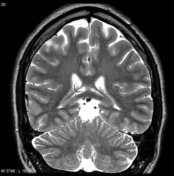 File:Normal coronal brain (Radiopaedia 6676-7910 Coronal T2 30).jpg