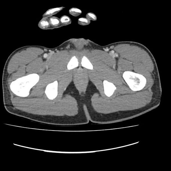 File:Normal dual-phase trauma CT chest,abdomen and pelvis (Radiopaedia 48092-52899 A 117).jpg