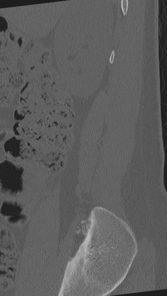 File:Normal lumbar spine CT (Radiopaedia 46533-50986 Sagittal bone window 93).png