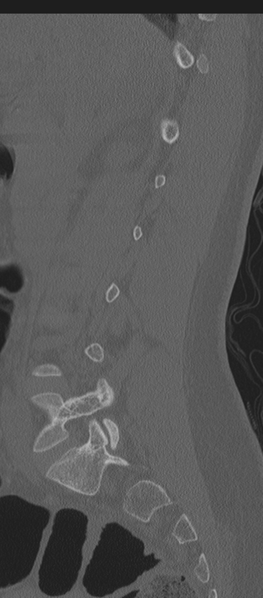 File:Normal lumbosacral CT (Radiopaedia 37923-39867 Sagittal bone window 65).png