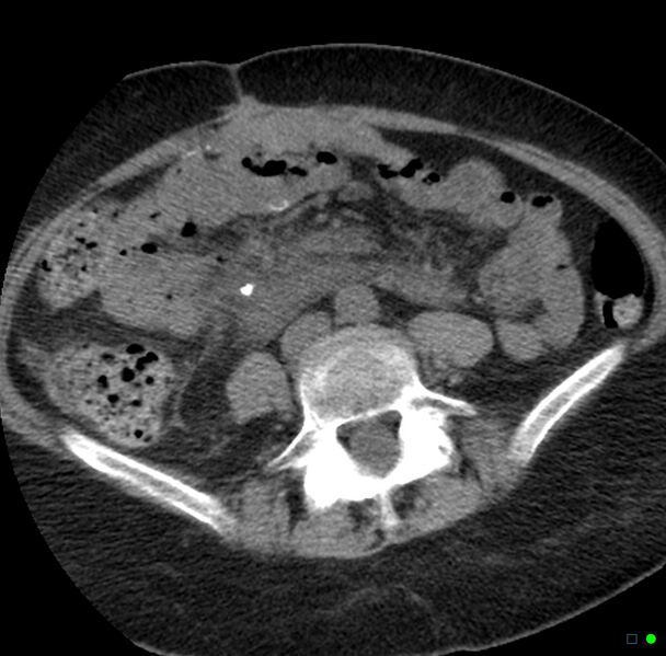 File:Obstructed infected horseshoe kidney (Radiopaedia 18116-17898 non-contrast 24).jpg