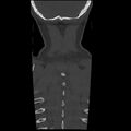 Occipital condyle fracture (Radiopaedia 31755-32691 Coronal bone window 38).jpg