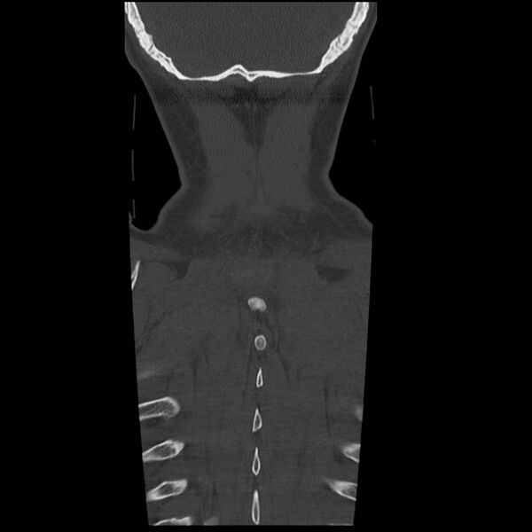 File:Occipital condyle fracture (Radiopaedia 31755-32691 Coronal bone window 38).jpg