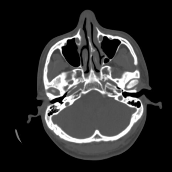 File:Occipital spur - asymptomatic (Radiopaedia 87753-104201 Axial bone window 28).jpg
