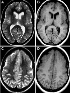 MRI-a,b,c,d)Developmental abnormalities/polymicrogyria in the frontal opercular cortex bilaterally